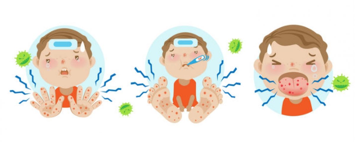 The Basics of Hand, Foot & Mouth Disease