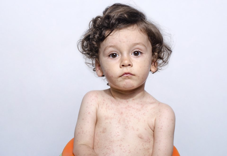 Protecting Your Baby from a Measles Outbreak FAQs